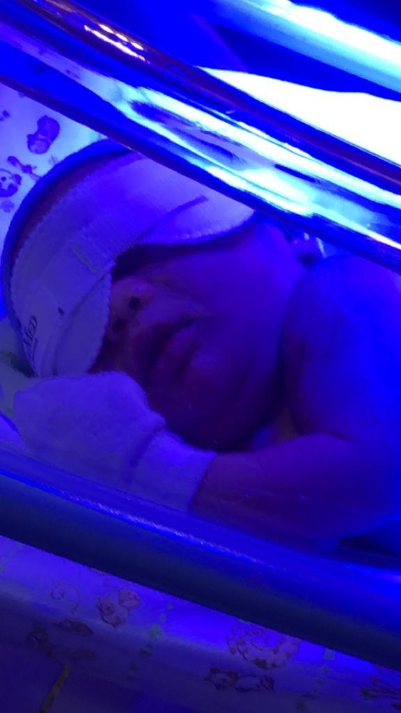 Icterícia em recém nascido