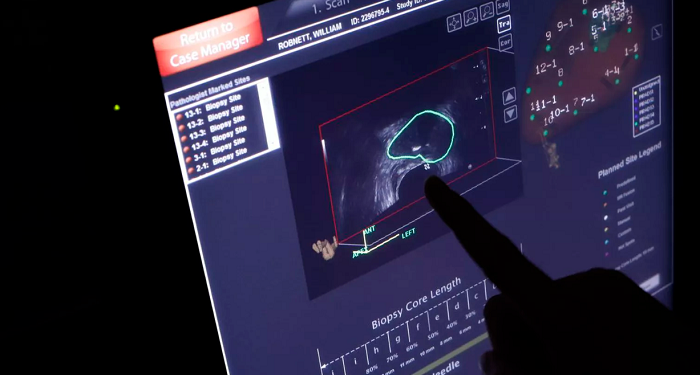 Pesquisadores encontram compensações favoráveis ​​​​do rastreamento de PSA para câncer de próstata