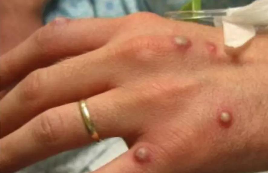 Porto Alegre investiga 1º caso suspeito de varíola dos macacos no Brasil