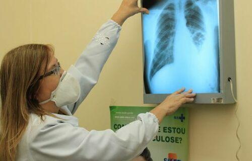 Brasil está entre os 30 países prioritários da OMS devido à carga de tuberculose e coinfecção tuberculose-HIV