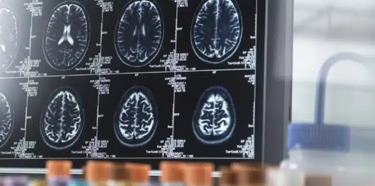 O que faz o cérebro envelhecer mais rápido?