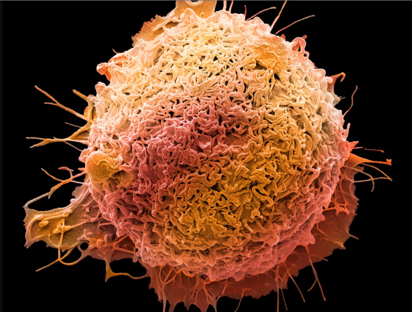 Médicos alertam para o ‘assustador’ crescimento do câncer colorretal em pessoas de até 50 anos