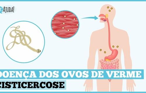 O que é cisticercose? Quais os sintomas e o tratamento?